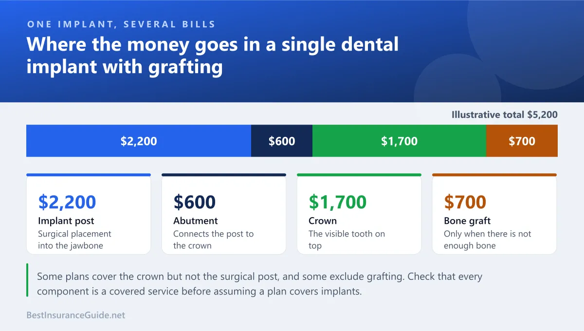Split chart showing how the total cost of a single dental implant divides between the post, abutment, crown and grafting